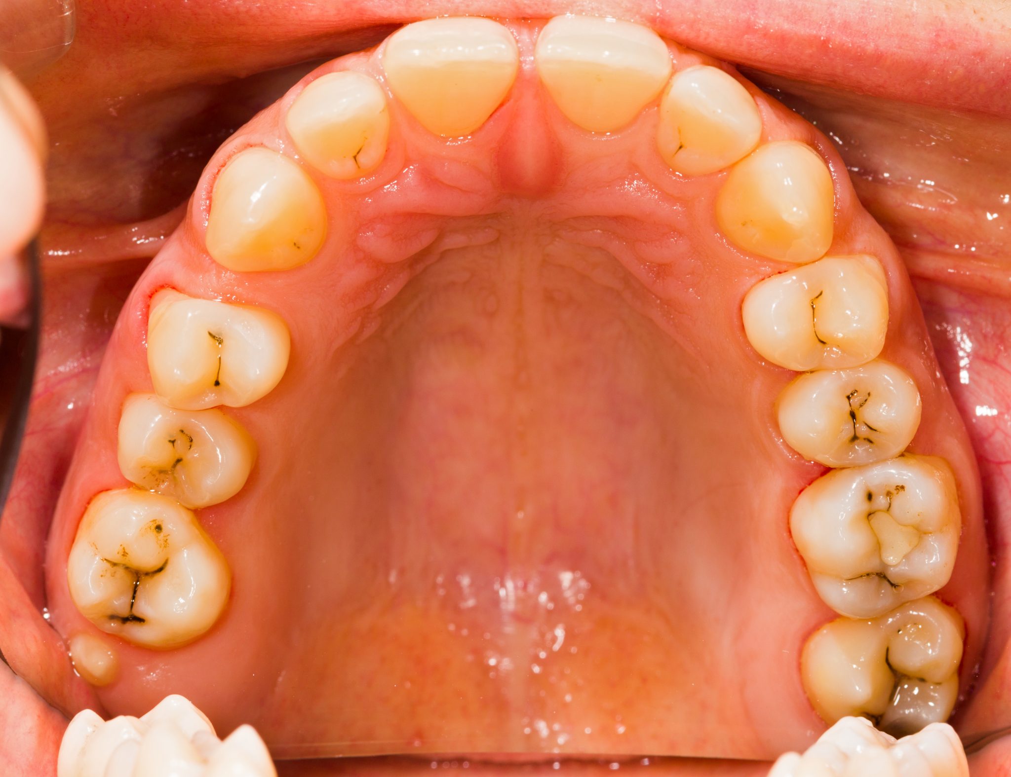 牙齿上的牙斑怎么去除,牙斑怎样快速去除,表面(第13页)_大山谷图库